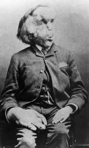 Joseph Merrick aka The Elephant Man